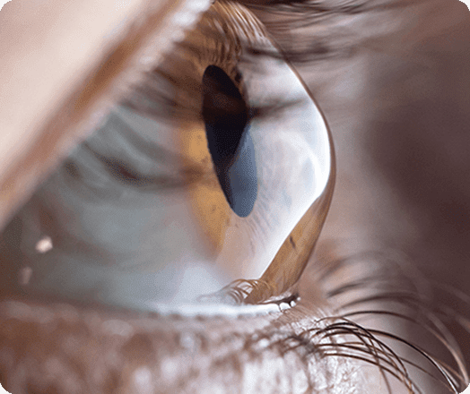 Keratoconus eye