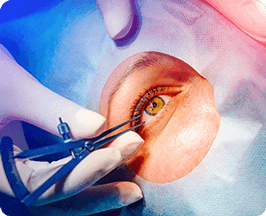 LASIK procedure in Washington Eye Doctors