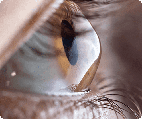 Eye with Keratoconus eye